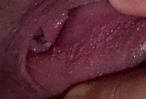 Is This Vestibular Papillomatosis Or An Std Sexual Health Forums