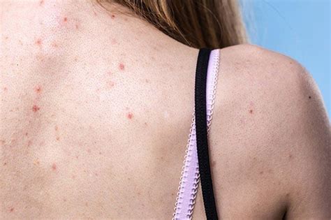 The Best Solutions To Treat Back Acne Grazia India