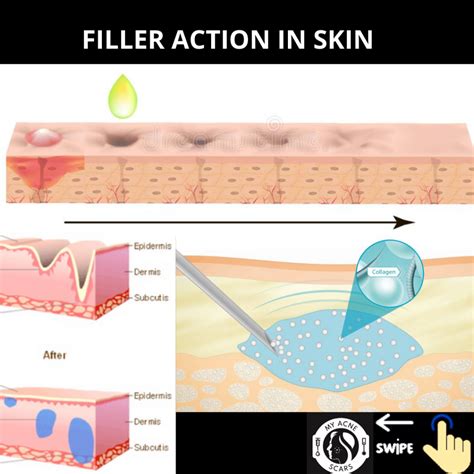 Filler For Acne Scars Overview My Acne Scars