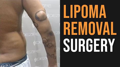 Latest Multiple Lipoma Removal By Vaser Technique Without Surgery