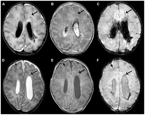 Punctate White Matter Lesions With A Linear Pattern Early Ac And