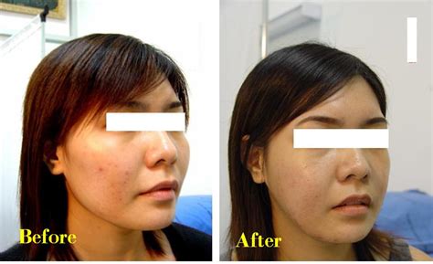 Plastic Surgery Photos Cheek Bone Reduction Before And After Photos