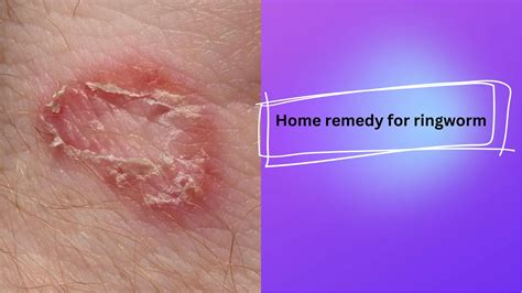 Natural Home Remedy For Ringworm Quickly Health Gadgetsng