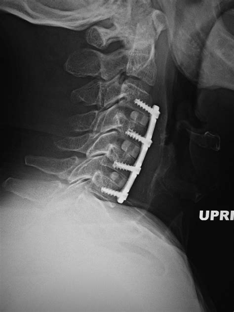 Types Of Anterior Cervical Fusion