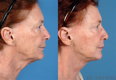 Facial Rejuvenation Before And After Pictures Case 53 Dallas Frisco