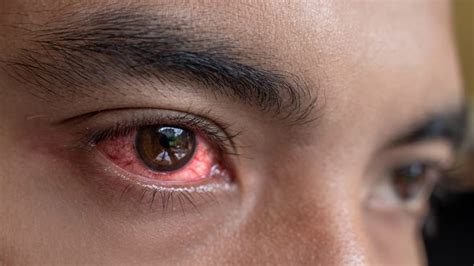 Home Remedies To Treat Bloodshot Eyes Onlymyhealth