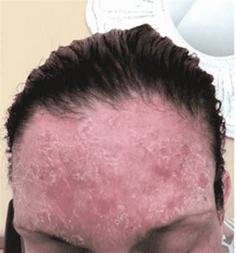 Cureus Thermoplastic Mask Induced Contact Dermatitis A Case Report