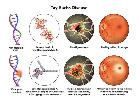 Tay Sachs Disease Photograph By Kateryna Kon Science Photo Library Fine Art America