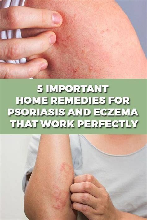 Home Remedies For Psoriasis Psoriasis Remedies Home Remedies For
