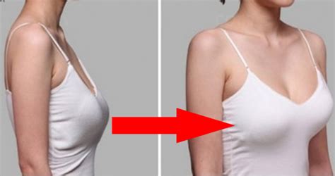 Увеличение груди каплевидными имплантатами Фото до и после маммопластики