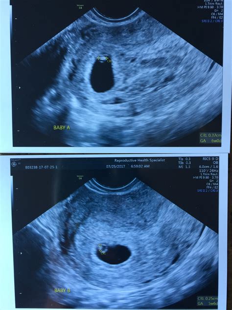 8 Week Ultrasound Pictures Twins