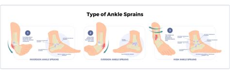 Ankle Sprains Different Types And Grades