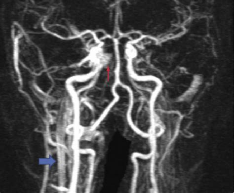 Contrast Enhanced Mri Angiogram Of A Right Direct Carotid Cavernous