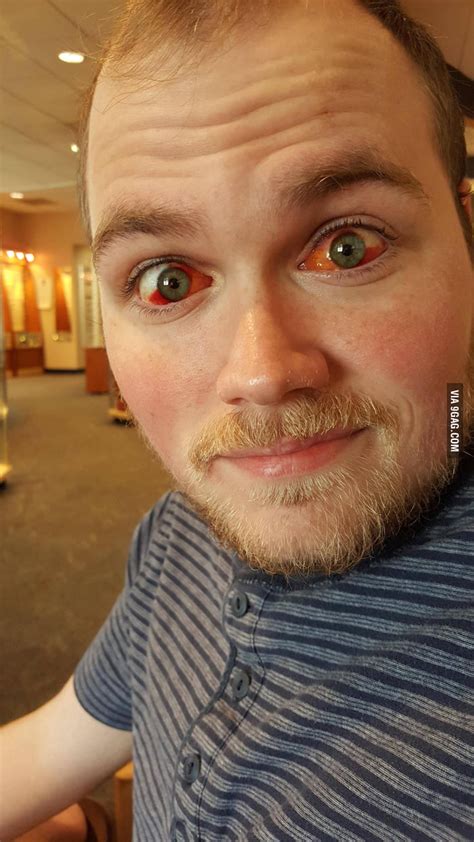 Lazy eye (amblyopia) is a condition in which one eye has poor vision due to a lack of coordination between the brain and eye. This guy just had lazy eye correction surgery. Uh, at ...