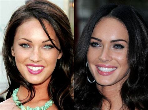 Celebrity Teeth Before And After Veneers Because Celebs Want The