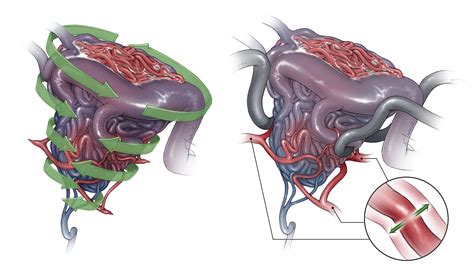 Nuances In Avm Resection The Neurosurgical Atlas