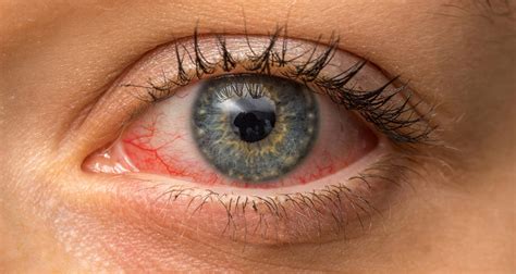Conjunctivitis Symptoms Causes And Treatment Flat Belly Bible