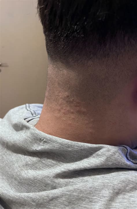 Why Does My Client Get These Bumps On His Head I Clean My Shavers