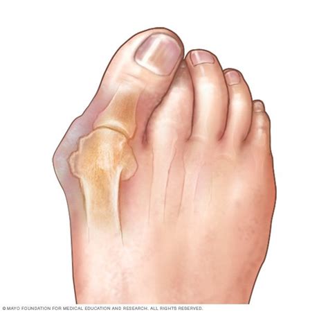 Bunions Disease Reference Guide