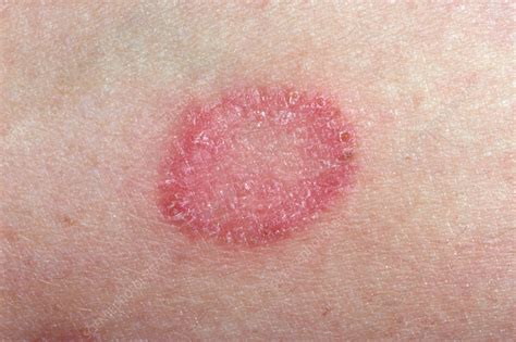 Ringworm Fungal Infection Stock Image C0348795 Science Photo Library