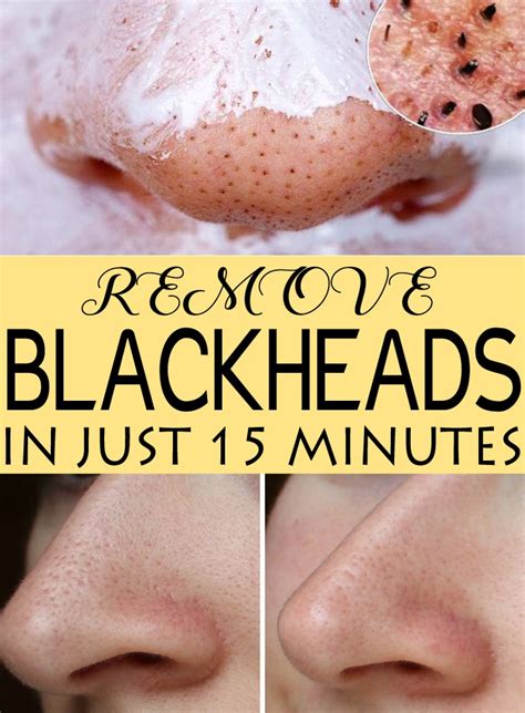 Diy How To Get Rid Of Blackheads In Just 15 Minutes