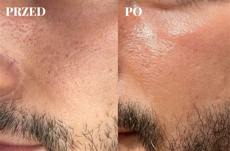 Wodorowe oczyszczanie skóry hydrogen na twarz szyję i dekolt