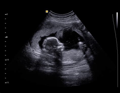First Look At Your Baby The Fascinating History Of The Sonogram