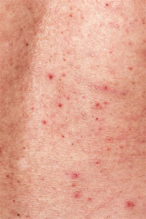 Scabies Infection On The Skin Photograph By Dr P Marazziscience Photo