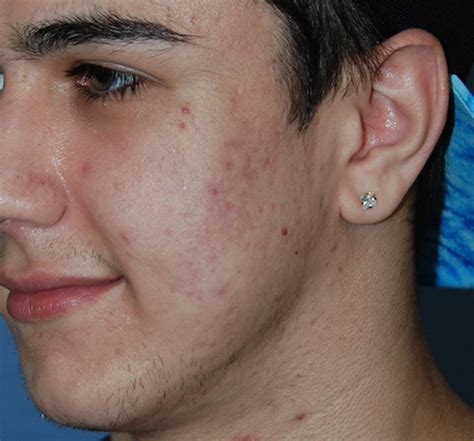 Acne Scar Treatment Before After Photos Seattle Bellevue