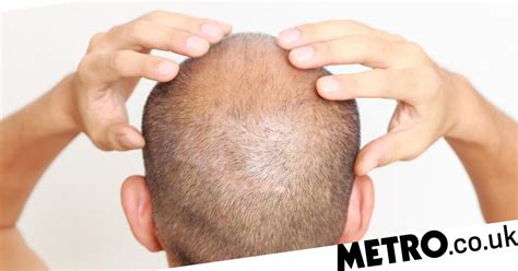 Cure For Baldness Possible After Molecule Breakthrough Metro News