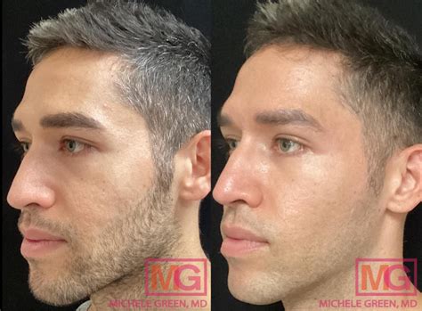 Top Acne Scar Treatments In 2023 Dr Michele Green Md