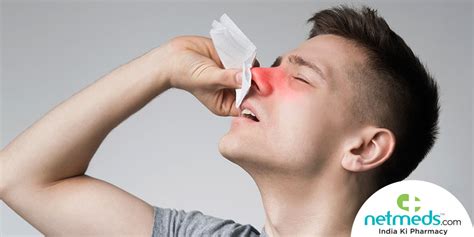 Nosebleedsepistaxis Causes Symptoms And Treatment