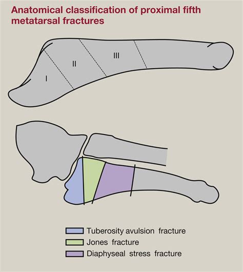 Fractures Of The Foot And Ankle Surgery Oxford International Edition
