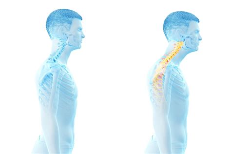How To Correct Forward Head Posture Greater Austin Pain Center