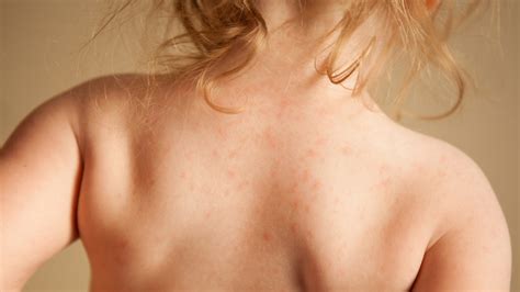 Hives from a food allergic reaction are different from the red, itchy rash that eczema causes. Food allergy symptoms FAQ: How to tell if your kid has a ...