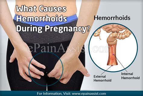 What Causes Hemorrhoids During Pregnancy Know Its Prevention And Treatment