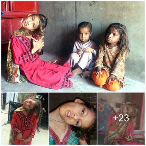 the ongoing struggle of afsheen a 9 year old pakistani girl with a rare spinal disorder