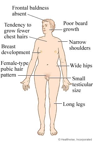 Klinefelter Syndrome Diagram