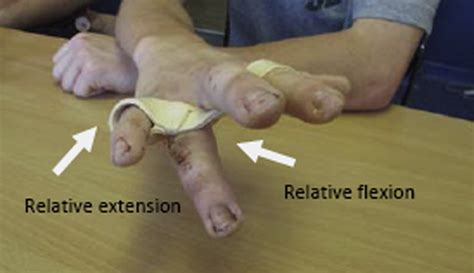 Relative Motion Orthoses In The Management Of Various Hand Conditions