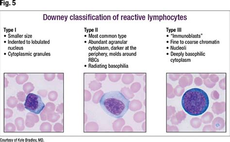 Differentiating Monocytes And Reactive Lymphocytes Rmedlabprofessionals