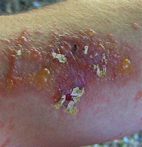 Poison Ivy Rash Causes Treatment And Prevention
