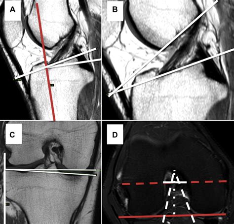 An Evaluation Of The Association Between Radiographic Intercondylar