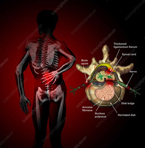 Causes Of Back Pain Illustration Stock Image C0276729 Science