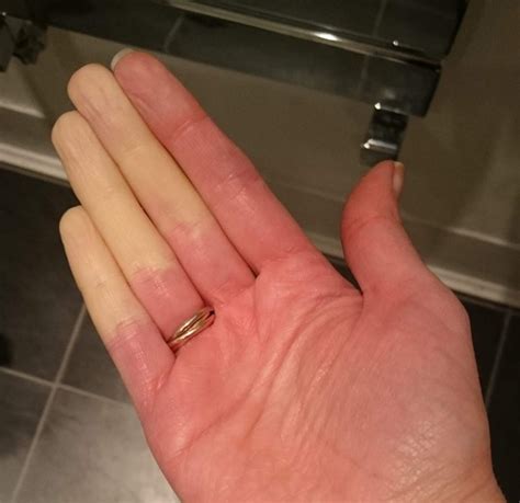 Raynauds The ‘cold Hand Syndrome That Affects One In Six People