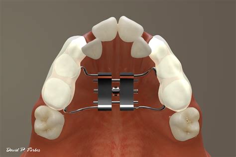 How Expanders Work Forbes Orthodontics