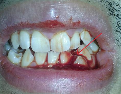 Severe Bleeding Gums Should I See A Dentist Or A Doctor Warning