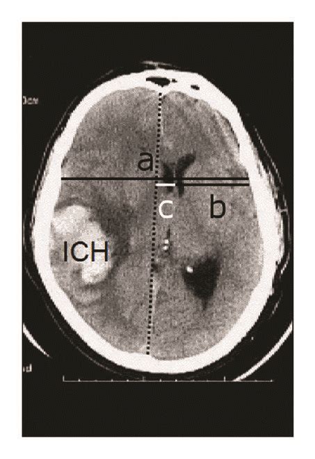 Assessment Of Midline Shift MLS On An Image Of Intracerebral Hematoma