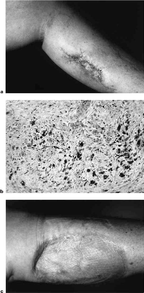 Figure 1 From Micrographic Surgery ‘slow Mohs In Cutaneous Sarcomas