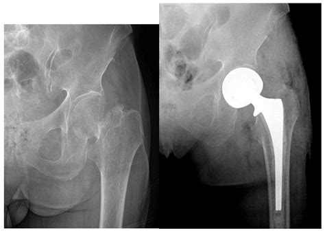 Geriatrics Free Full Text Surgical Treatment Of Femoral Neck
