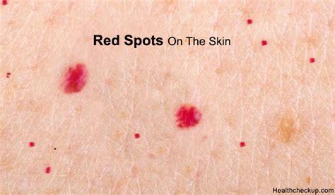 What Causes Red Spots On The Skin How To Get Rid Of The Red Spots On Skin